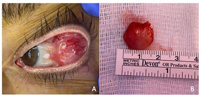 Bilateral orbital plasmacytomas as first sign of extramedullary progression post CAR-T therapy: case report and literature review